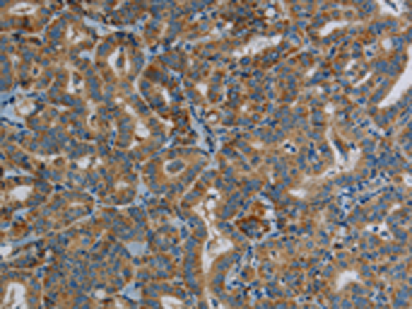 Immunohistochemistry of paraffin-embedded Human thyroid cancer tissue using TA371465 (PPARGC1B Antibody) at dilution 1/30 (Original magnification: x200)