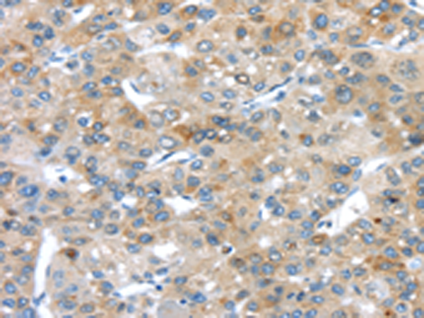 Immunohistochemistry of paraffin-embedded Human liver cancer tissue using TA371466 (PLXNA3 Antibody) at dilution 1/20 (Original magnification: x200)
