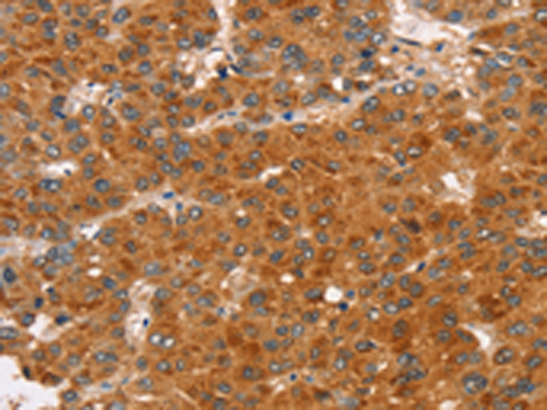 Immunohistochemistry of paraffin-embedded Human liver cancer tissue using TA371476 (RASA3 Antibody) at dilution 1/35 (Original magnification: x200)