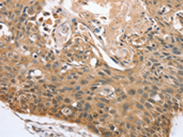 Immunohistochemistry of paraffin-embedded Human esophagus cancer tissue using TA371477 (RBM38 Antibody) at dilution 1/45 (Original magnification: x200)