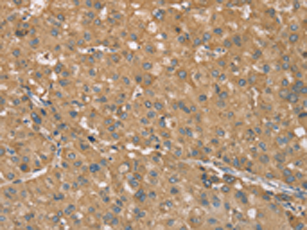 Immunohistochemistry of paraffin-embedded Human liver cancer tissue using TA371487 (RNF148 Antibody) at dilution 1/40 (Original magnification: x200)