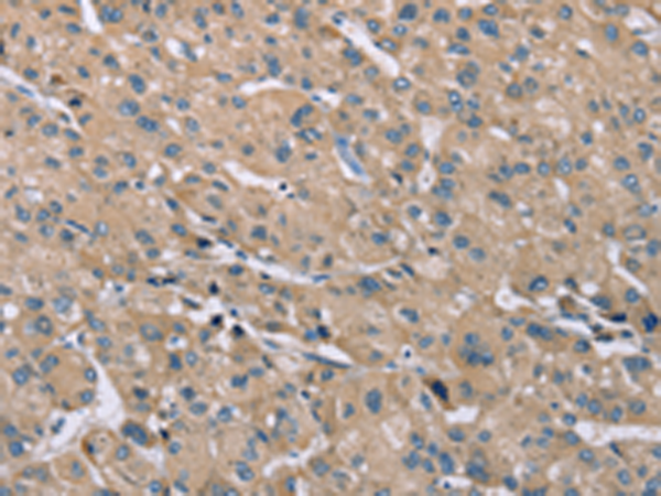 Immunohistochemistry of paraffin-embedded Human liver cancer tissue using TA371494 (SAMD9L Antibody) at dilution 1/30 (Original magnification: x200)