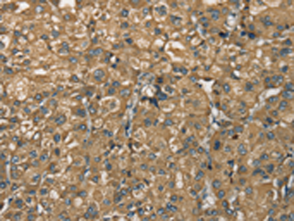 Immunohistochemistry of paraffin-embedded Human liver cancer tissue using TA371500 (NEMF Antibody) at dilution 1/30 (Original magnification: x200)