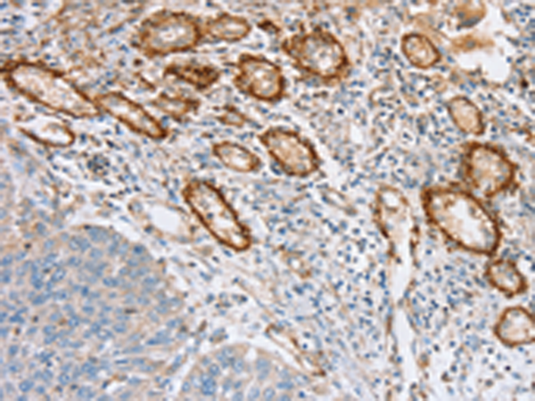 Immunohistochemistry of paraffin-embedded Human lung cancer tissue using TA371503 (SEMA7A Antibody) at dilution 1/35 (Original magnification: x200)