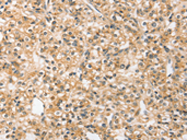 Immunohistochemistry of paraffin-embedded Human prostate cancer tissue using TA371521 (SLC44A2 Antibody) at dilution 1/20 (Original magnification: x200)