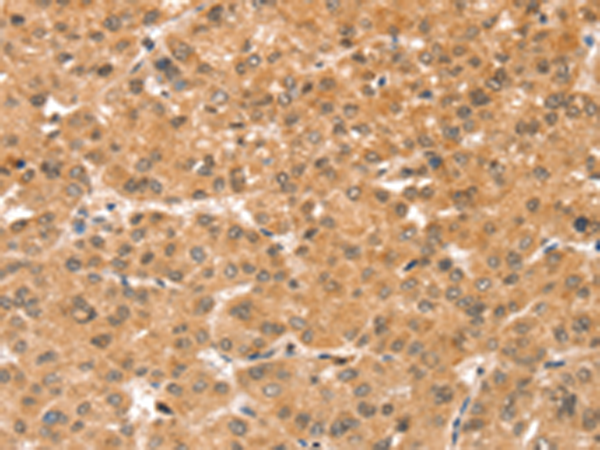 Immunohistochemistry of paraffin-embedded Human liver cancer tissue using TA371537 (SNX30 Antibody) at dilution 1/35 (Original magnification: x200)