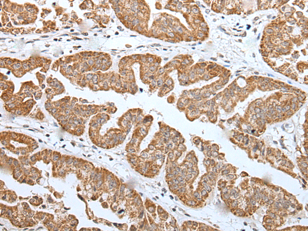 Immunohistochemistry of paraffin-embedded Human liver cancer tissue using TA371565 (TRIM71 Antibody) at dilution 1/25 (Original magnification: x200)