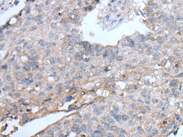 Immunohistochemistry of paraffin-embedded Human lung cancer tissue using TA371578 (TRIP11 Antibody) at dilution 1/20 (Original magnification: x200)