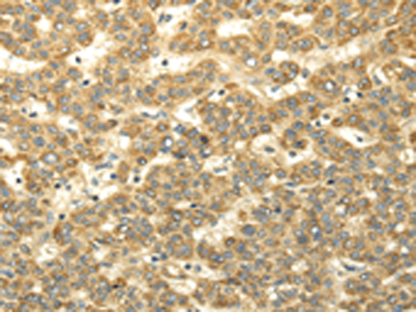 Immunohistochemistry of paraffin-embedded Human liver cancer tissue using TA371602 (WDR91 Antibody) at dilution 1/35 (Original magnification: x200)