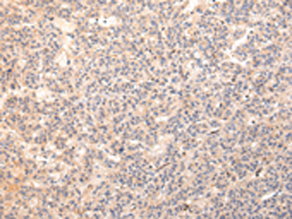 Immunohistochemistry of paraffin-embedded Human liver cancer tissue using TA371629 (ZPR1 Antibody) at dilution 1/20 (Original magnification: x200)