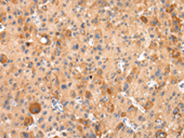 Immunohistochemistry of paraffin-embedded Human liver cancer tissue using TA371639 (AQP7 Antibody) at dilution 1/20 (Original magnification: x200)