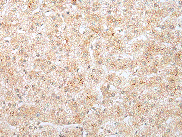Immunohistochemistry of paraffin-embedded Human liver cancer tissue using TA371778 (KRTAP11-1 Antibody) at dilution 1/20 (Original magnification: x200)