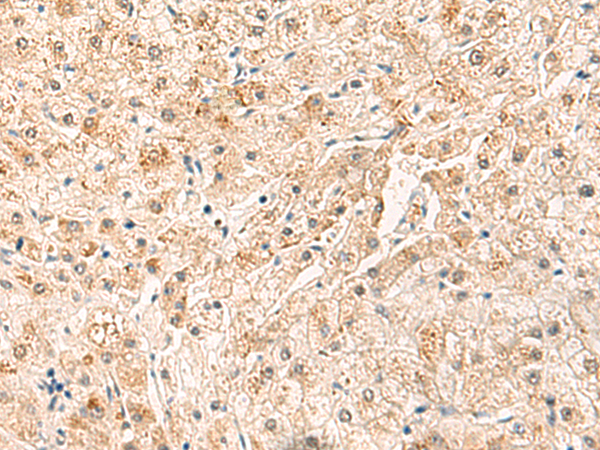Immunohistochemistry of paraffin-embedded Human liver cancer tissue using TA371780 (SYT16 Antibody) at dilution 1/30 (Original magnification: x200)
