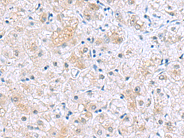 Immunohistochemistry of paraffin-embedded Human liver cancer tissue using TA371793 (NUDT8 Antibody) at dilution 1/35 (Original magnification: x200)