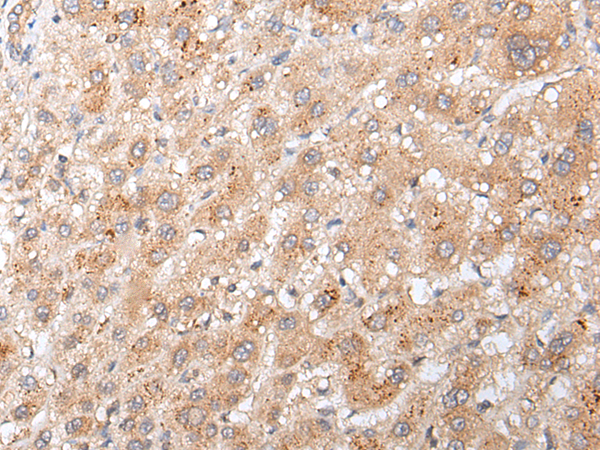 Immunohistochemistry of paraffin-embedded Human liver cancer tissue using TA371799 (GADD45GIP1 Antibody) at dilution 1/20 (Original magnification: x200)
