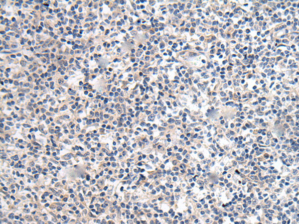 HEK293T cells were transfected with the pCMV6-ENTRY control (Left lane) or pCMV6-ENTRY SERPINB3 (RC202683, Right lane) cDNA for 48 hrs and lysed. Equivalent amounts of cell lysates (5 ug per lane) were separated by SDS-PAGE and immunoblotted with anti-SERPINB3. Positive lysates LY416321 (100 ug) and LC416321 (20 ug) can be purchased separately from OriGene.