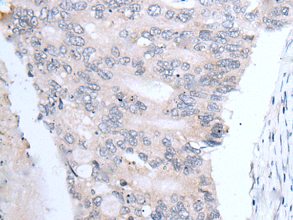 Immunohistochemistry of paraffin-embedded Human colorectal cancer tissue using TA371887 (FABP12 Antibody) at dilution 1/25 (Original magnification: x200)