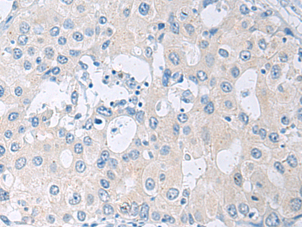 Immunohistochemistry of paraffin-embedded Human breast cancer tissue using TA371985 (SLC23A1 Antibody) at dilution 1/30 (Original magnification: x200)