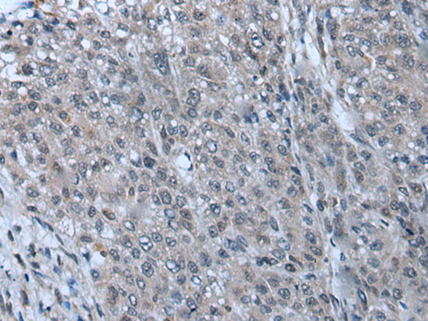 Immunohistochemistry of paraffin-embedded Human liver cancer tissue using TA371998 (ZNF143 Antibody) at dilution 1/20 (Original magnification: x200)