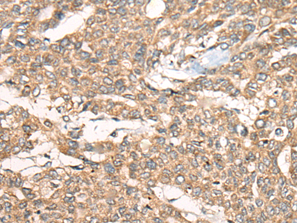 Immunohistochemistry of paraffin-embedded Human liver cancer tissue using TA372004 (ZXDA Antibody) at dilution 1/30 (Original magnification: x200)