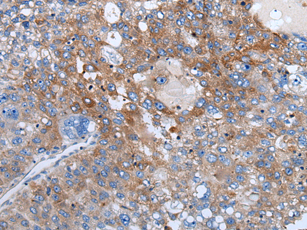 Immunohistochemistry of paraffin-embedded Human liver cancer tissue using TA372035 (WEE2 Antibody) at dilution 1/40 (Original magnification: x200)