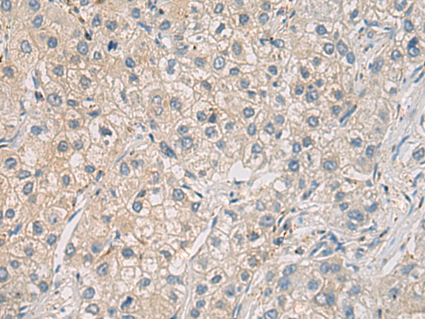 Immunohistochemistry of paraffin-embedded Human liver cancer tissue using TA372037 (WFDC3 Antibody) at dilution 1/40 (Original magnification: x200)