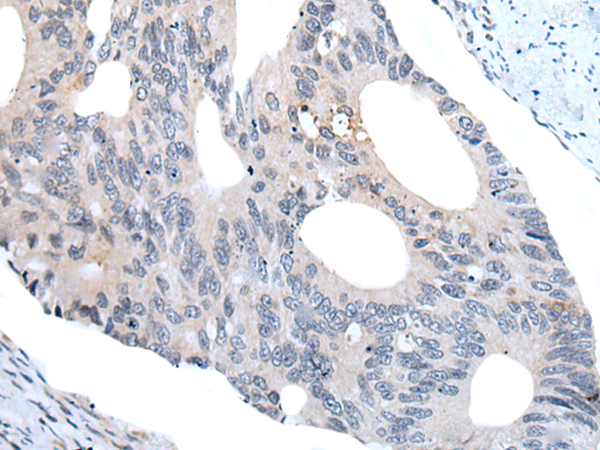Immunohistochemistry of paraffin-embedded Human colorectal cancer tissue using TA372042 (WIPF2 Antibody) at dilution 1/25 (Original magnification: x200)
