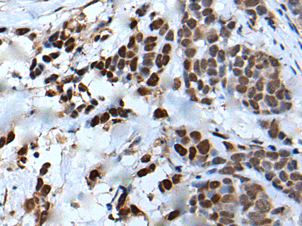 Immunohistochemistry of paraffin-embedded Human thyroid cancer tissue using TA372054 (VEZT Antibody) at dilution 1/50 (Original magnification: x200)