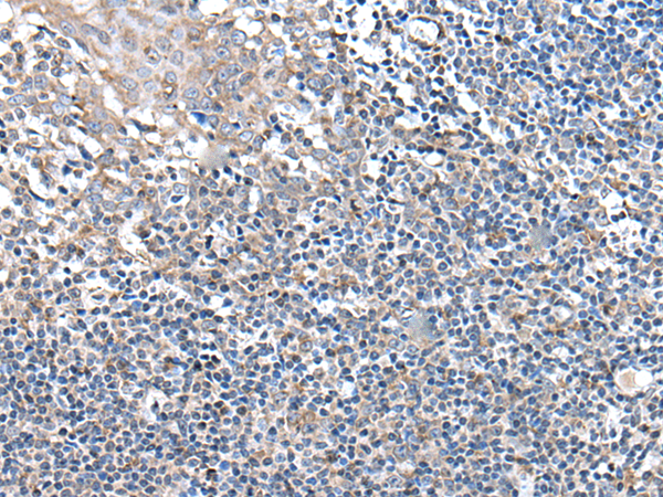 HEK293T cells were transfected with the pCMV6-ENTRY control (Left lane) or pCMV6-ENTRY SMAD1 (RC223918, Right lane) cDNA for 48 hrs and lysed. Equivalent amounts of cell lysates (5 ug per lane) were separated by SDS-PAGE and immunoblotted with anti-SMAD1 (1:500).