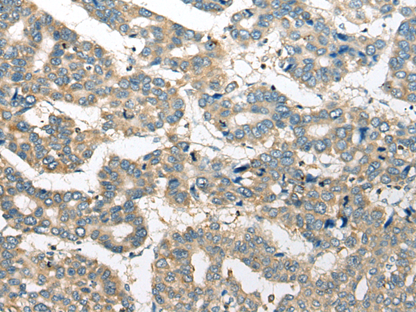 Immunohistochemistry of paraffin-embedded Human liver cancer tissue using TA372067 (UBXN10 Antibody) at dilution 1/20 (Original magnification: x200)