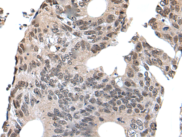 Immunohistochemistry of paraffin-embedded Human colorectal cancer tissue using TA372077 (UNCX Antibody) at dilution 1/25 (Original magnification: x200)