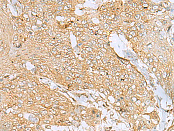 Immunohistochemistry of paraffin-embedded Human esophagus cancer tissue using TA372080 (USP24 Antibody) at dilution 1/20 (Original magnification: x200)