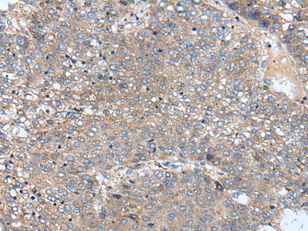 HEK293T cells were transfected with the pCMV6-ENTRY control (Cat# PS100001, Left lane) or pCMV6-ENTRY GCLC (Cat# RC207915, Right lane) cDNA for 48 hrs and lysed. Equivalent amounts of cell lysates (5 ug per lane) were separated by SDS-PAGE and immunoblotted with anti-GCLC(Cat# TA507318). Positive lysates [LY419901] (100 ug) and [LC419901] (20 ug) can be purchased separately from OriGene.