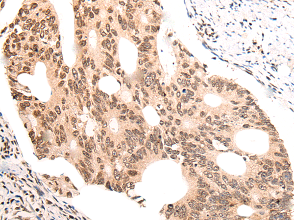 Immunohistochemistry of paraffin-embedded Human colorectal cancer tissue using TA372140 (KNOP1 Antibody) at dilution 1/55 (Original magnification: x200)