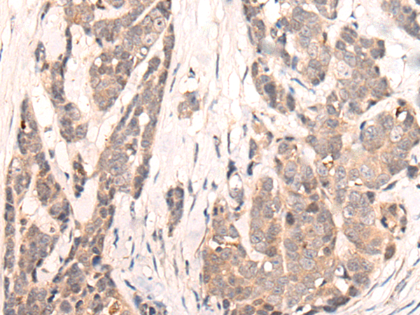 Immunohistochemistry of paraffin-embedded Human thyroid cancer tissue using TA372145 (SIGLECL1 Antibody) at dilution 1/25 (Original magnification: x200)