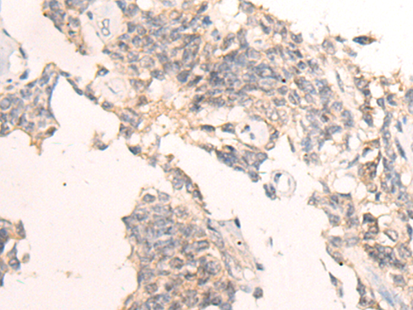 Immunohistochemistry of paraffin-embedded Human ovarian cancer tissue using TA372146 (IBA57 Antibody) at dilution 1/65 (Original magnification: x200)