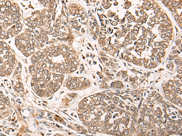 Immunohistochemistry of paraffin-embedded Human esophagus cancer tissue using TA372155 (CA5B Antibody) at dilution 1/85 (Original magnification: x200)