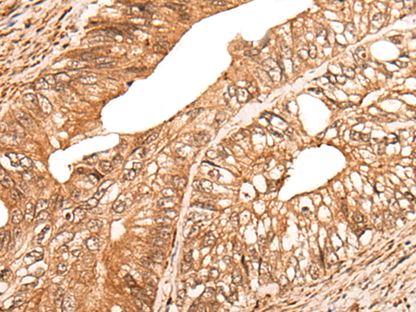 Immunohistochemistry of paraffin-embedded Human colorectal cancer tissue using TA372158 (CACNA2D2 Antibody) at dilution 1/35 (Original magnification: x200)