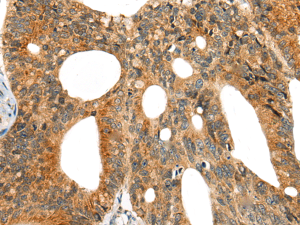 Immunohistochemistry of paraffin-embedded Human colorectal cancer tissue using TA372177 (CASS4 Antibody) at dilution 1/30 (Original magnification: x200)