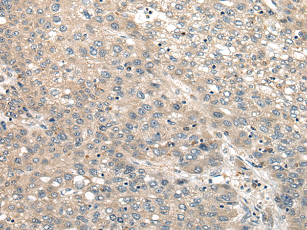 Immunohistochemistry of paraffin-embedded Human liver cancer tissue using TA372182 (CBLN1 Antibody) at dilution 1/20 (Original magnification: x200)