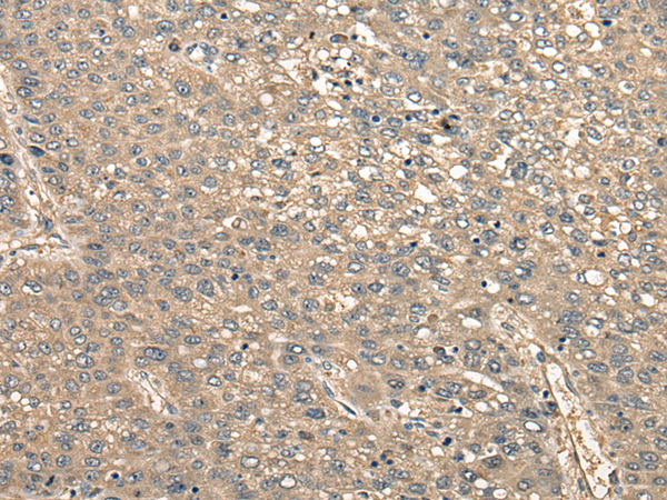 Immunohistochemistry of paraffin-embedded Human liver cancer tissue using TA372186 (CCDC102A Antibody) at dilution 1/30 (Original magnification: x200)