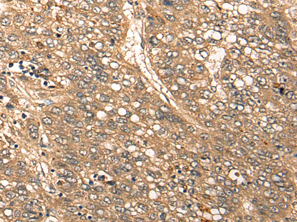 Immunohistochemistry of paraffin-embedded Human liver cancer tissue using TA372209 (CDRT15L2 Antibody) at dilution 1/20 (Original magnification: x200)