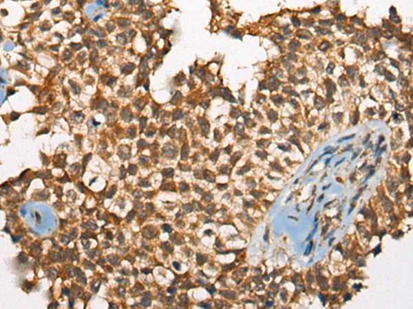 Immunohistochemistry of paraffin-embedded Human ovarian cancer tissue using TA372218 (ODF2 Antibody) at dilution 1/110 (Original magnification: x200)