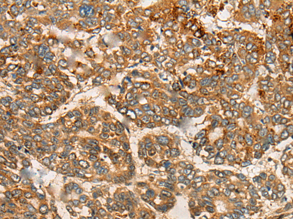 Immunohistochemistry of paraffin-embedded Human liver cancer tissue using TA372221 (CNTLN Antibody) at dilution 1/30 (Original magnification: x200)