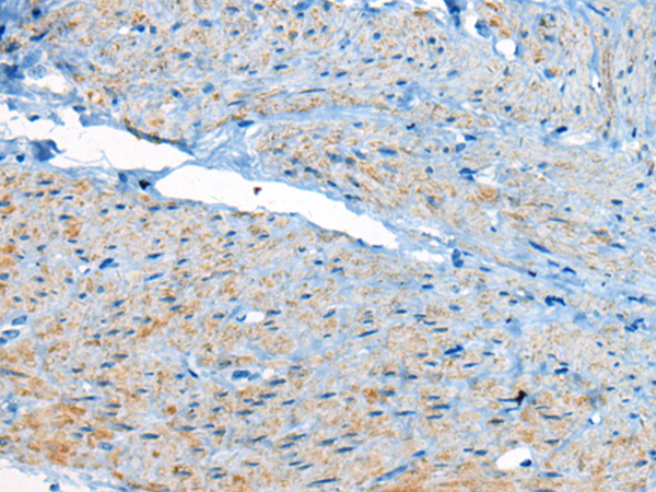 Immunohistochemistry of paraffin-embedded Human cervical cancer tissue using TA372222 (CEP104 Antibody) at dilution 1/25 (Original magnification: x200)