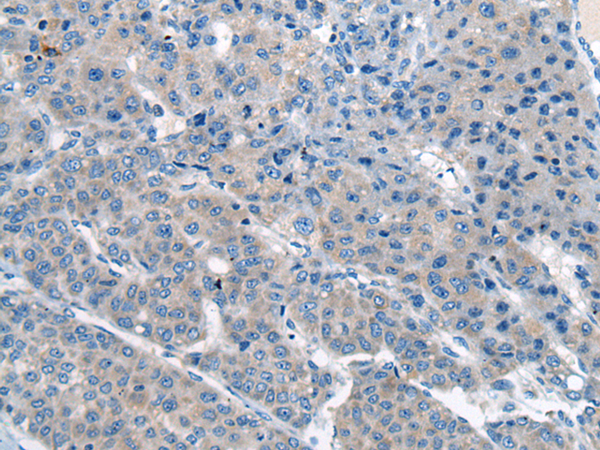 Immunohistochemistry of paraffin-embedded Human liver cancer tissue using TA372243 (CITED4 Antibody) at dilution 1/65 (Original magnification: x200)