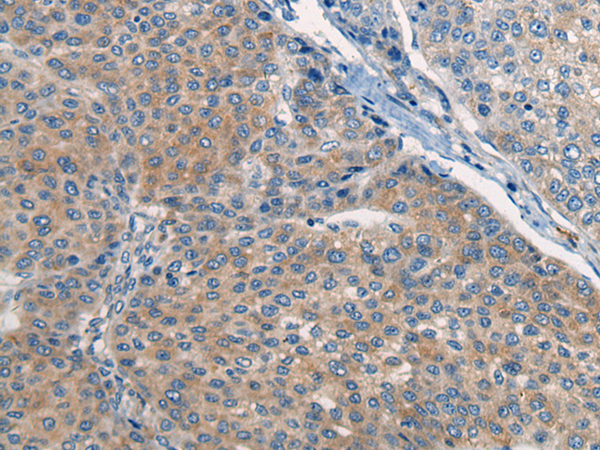 Immunohistochemistry of paraffin-embedded Human liver cancer tissue using TA372258 (CNTN5 Antibody) at dilution 1/35 (Original magnification: x200)