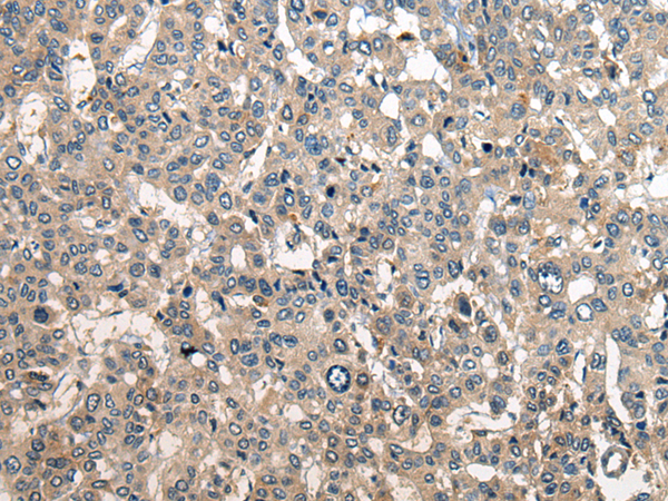 Immunohistochemistry of paraffin-embedded Human liver cancer tissue using TA372267 (RCOR2 Antibody) at dilution 1/25 (Original magnification: x200)