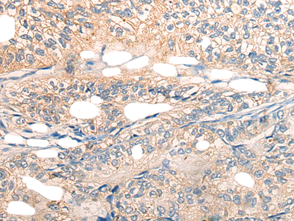 Immunohistochemistry of paraffin-embedded Human gastric cancer tissue using TA372314 (ABCC6 Antibody) at dilution 1/25 (Original magnification: x200)