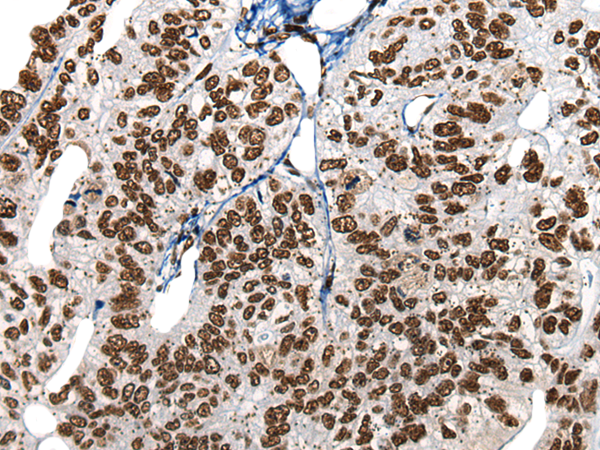 Immunohistochemistry of paraffin-embedded Human gastric cancer tissue using TA372315 (HNRNPR Antibody) at dilution 1/20 (Original magnification: x200)